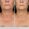 ELASTIderm® Neck and Decollete Concentrate - Image 4
