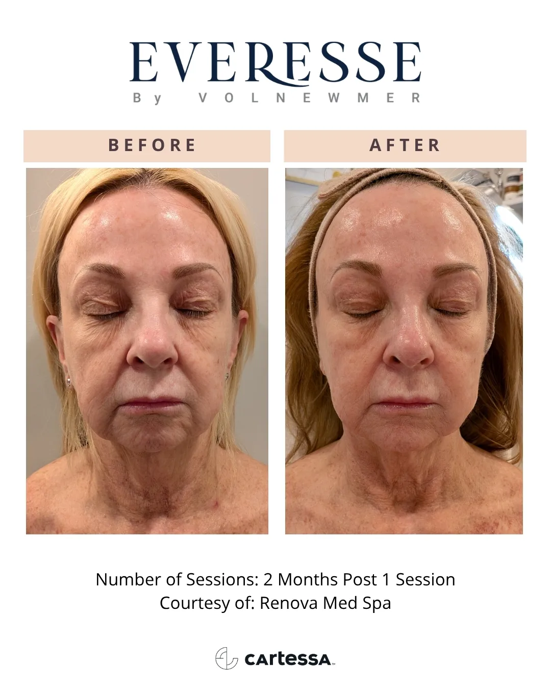 After before-syracuse medical aesthetics in Syracuse, NY