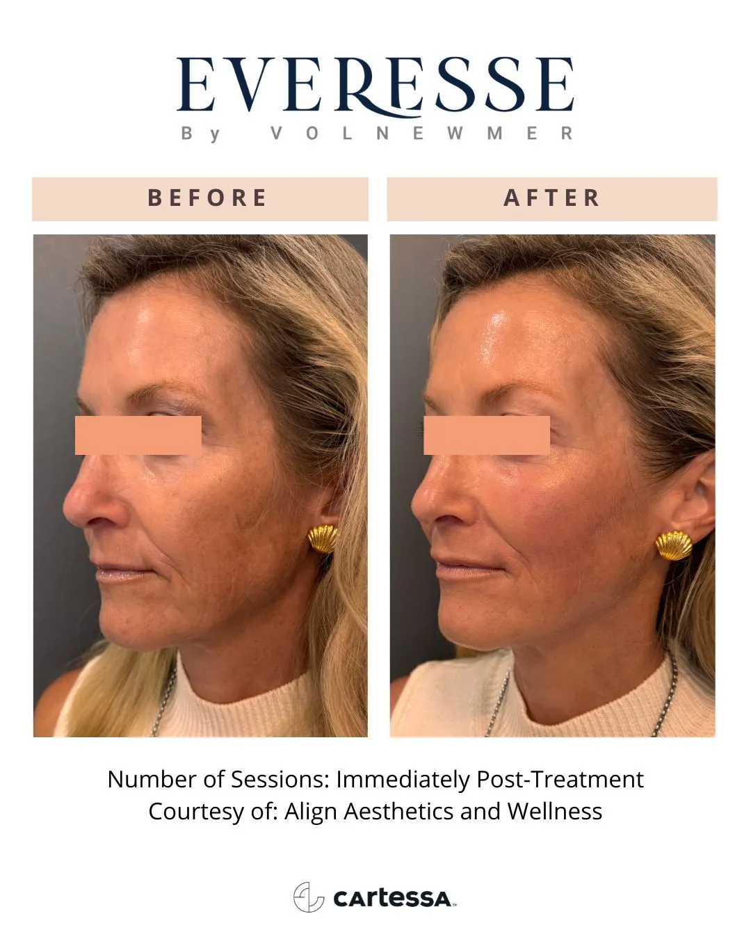 AlignAesthetics-syracuse medical aesthetics in Syracuse, NY
