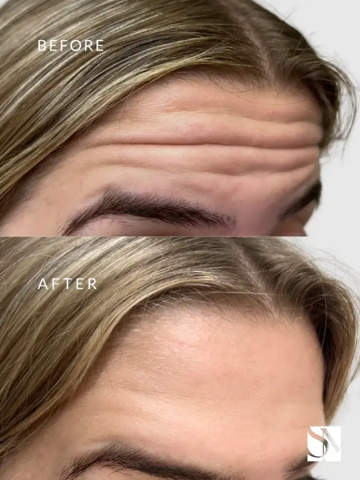 BOTOX After before-syracuse medical aesthetics in Syracuse, NY