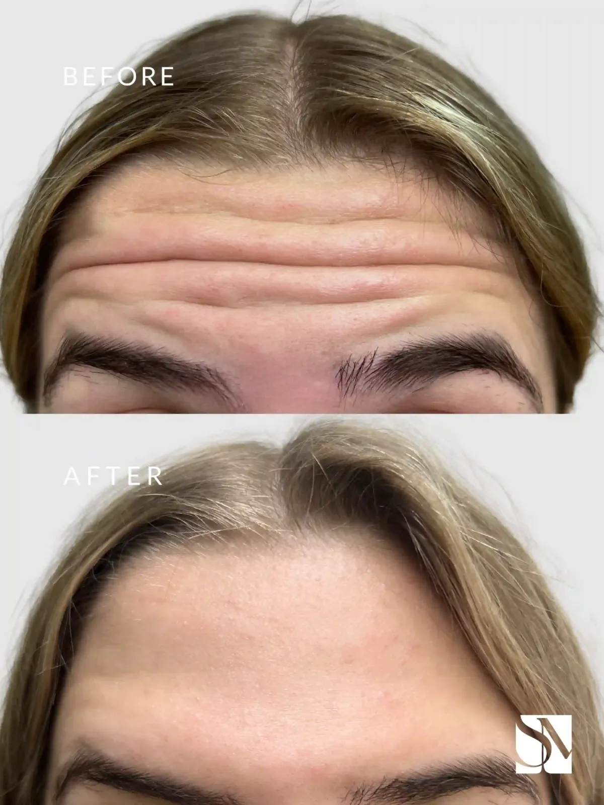 BOTOX After-syracuse medical aesthetics in Syracuse, NY