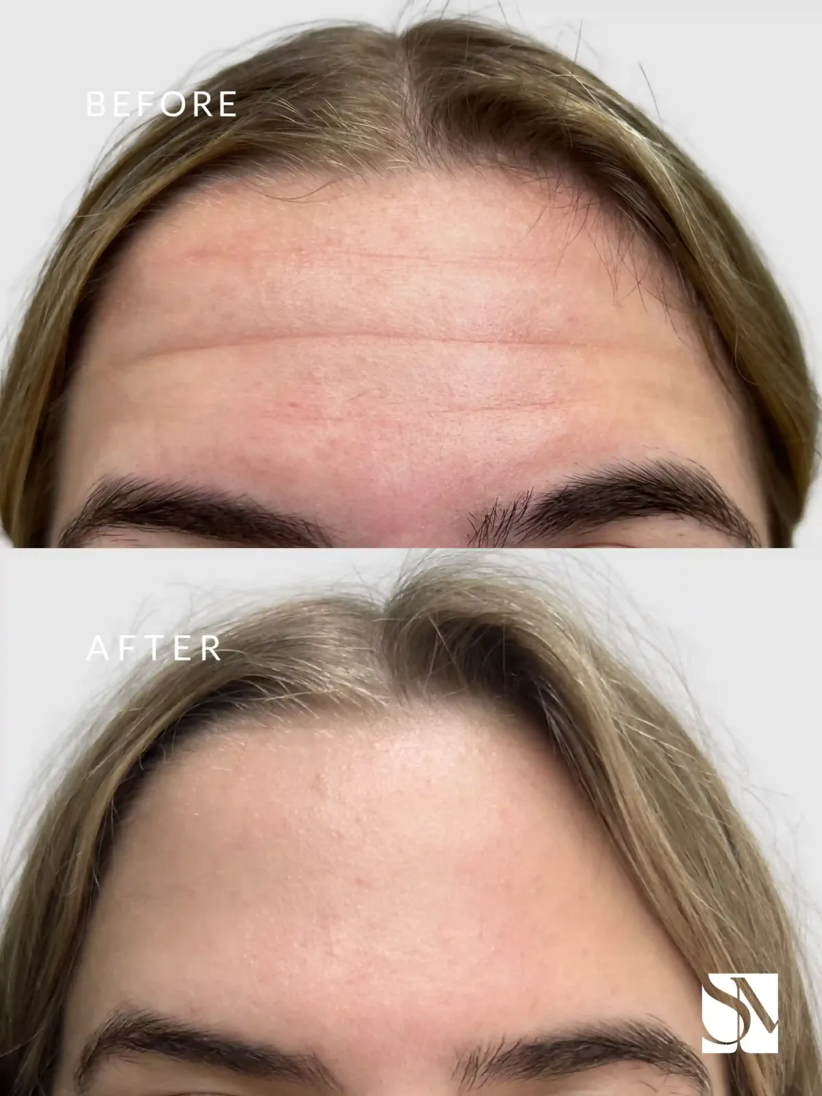 BOTOX-syracuse medical aesthetics in Syracuse, NY