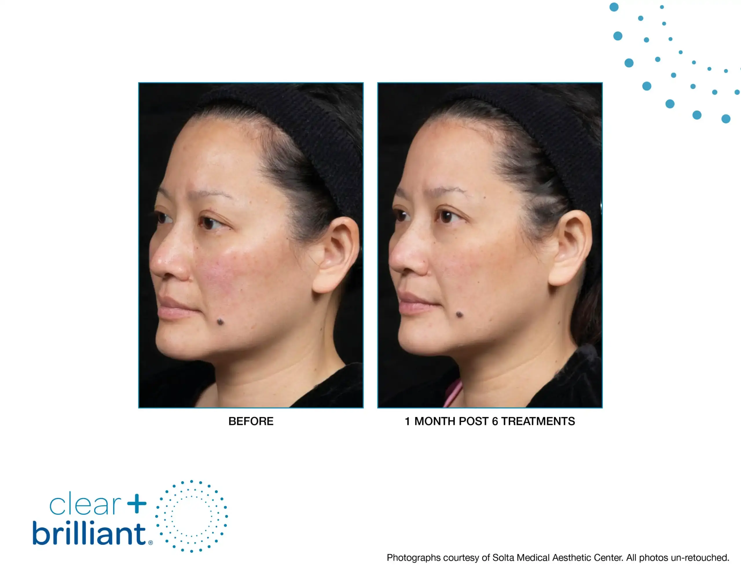 CB Before After SMAC_05-syracuse medical aesthetics in Syracuse, NY