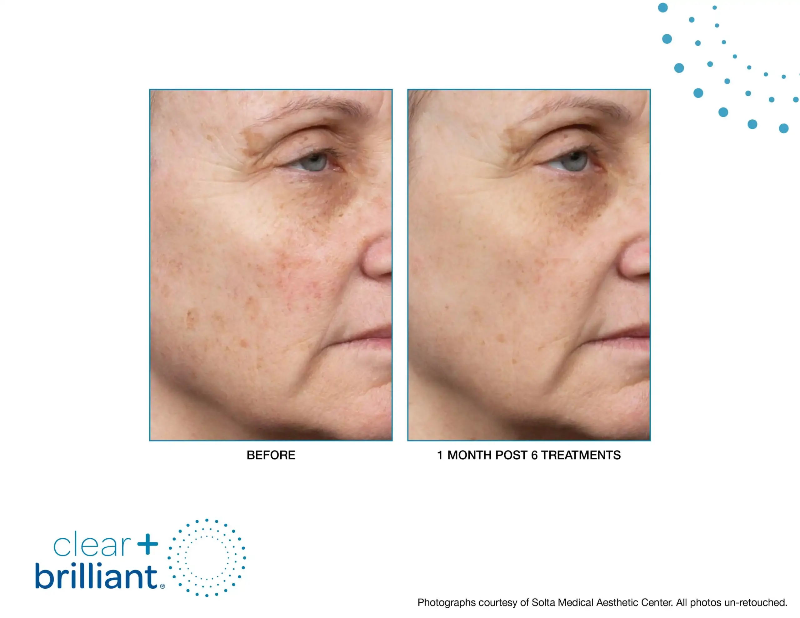 CB Before After SMAC_08-syracuse medical aesthetics in Syracuse, NY