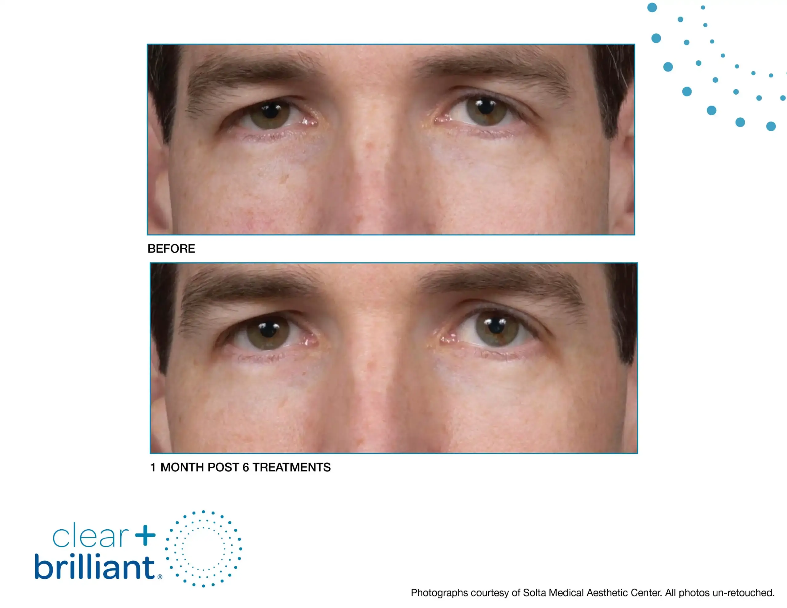 CB Before After SMAC_09-syracuse medical aesthetics in Syracuse, NY