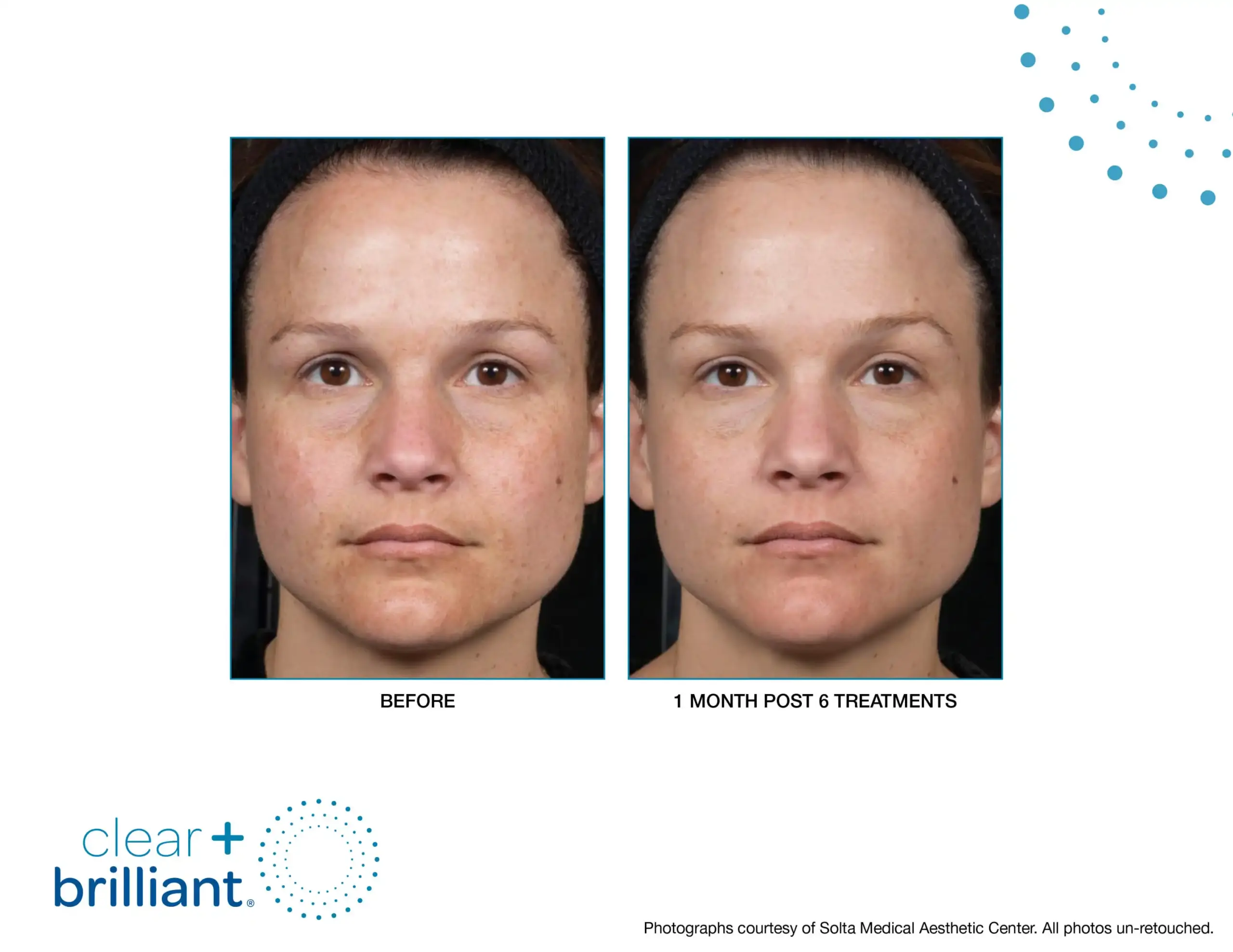 CB Before After SMAC_10-syracuse medical aesthetics in Syracuse, NY