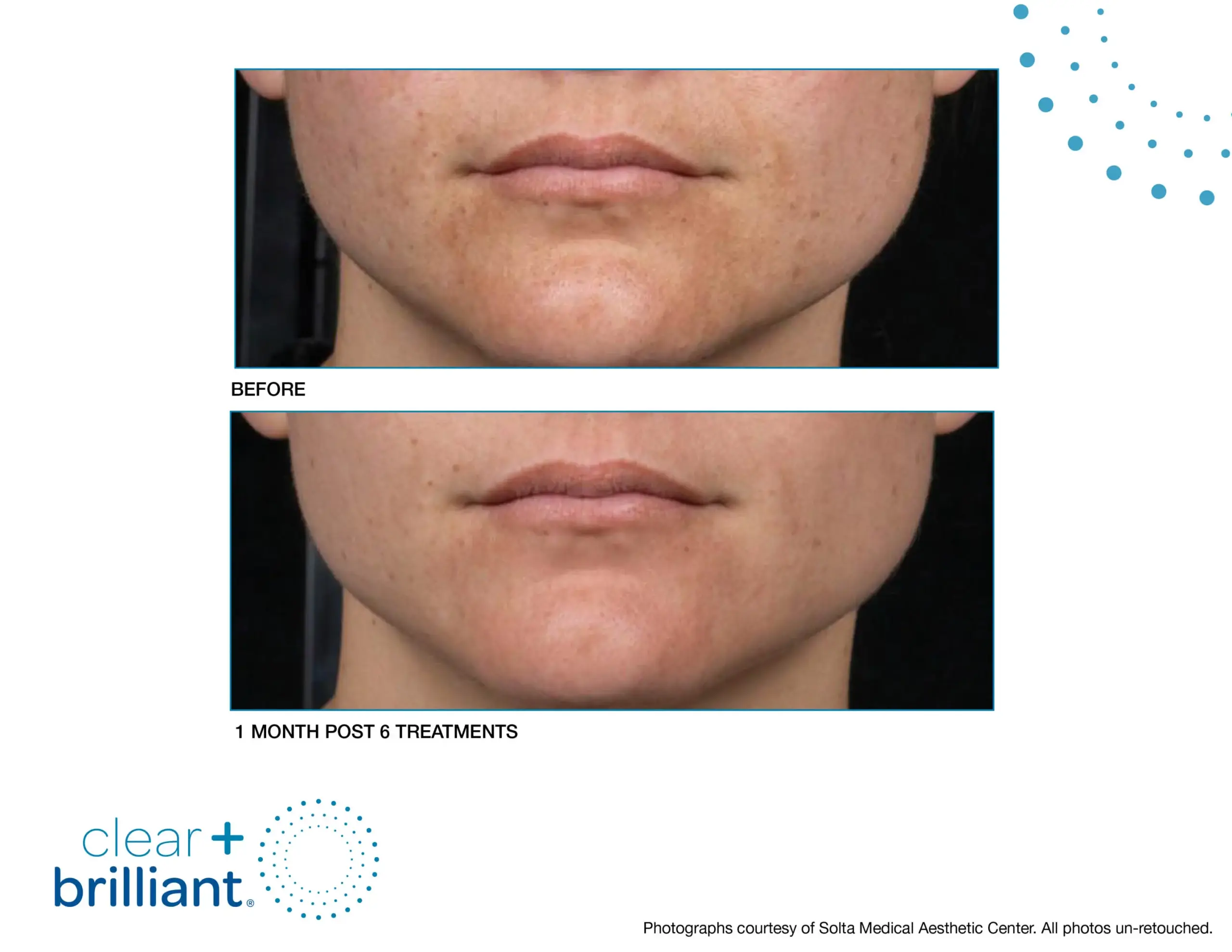 CB Before After SMAC_11-syracuse medical aesthetics in Syracuse, NY