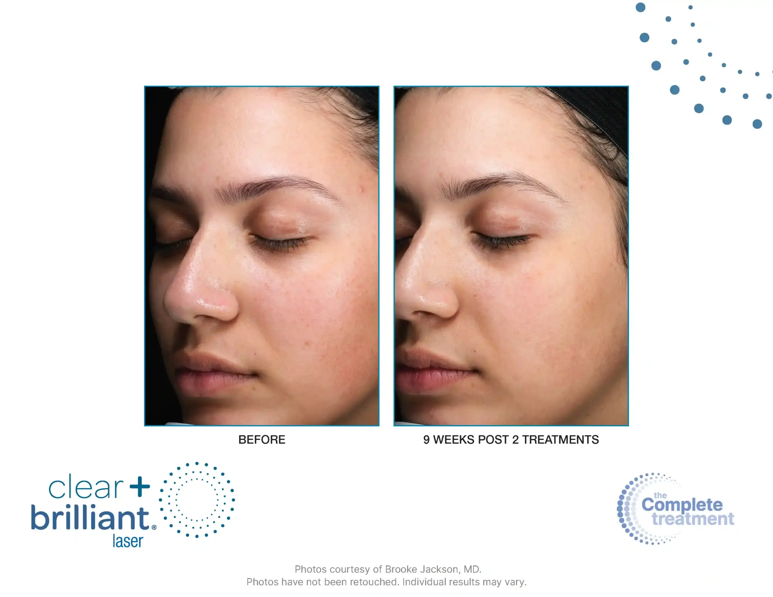 CB Touch B&A Master - 001-syracuse medical aesthetics in Syracuse, NY