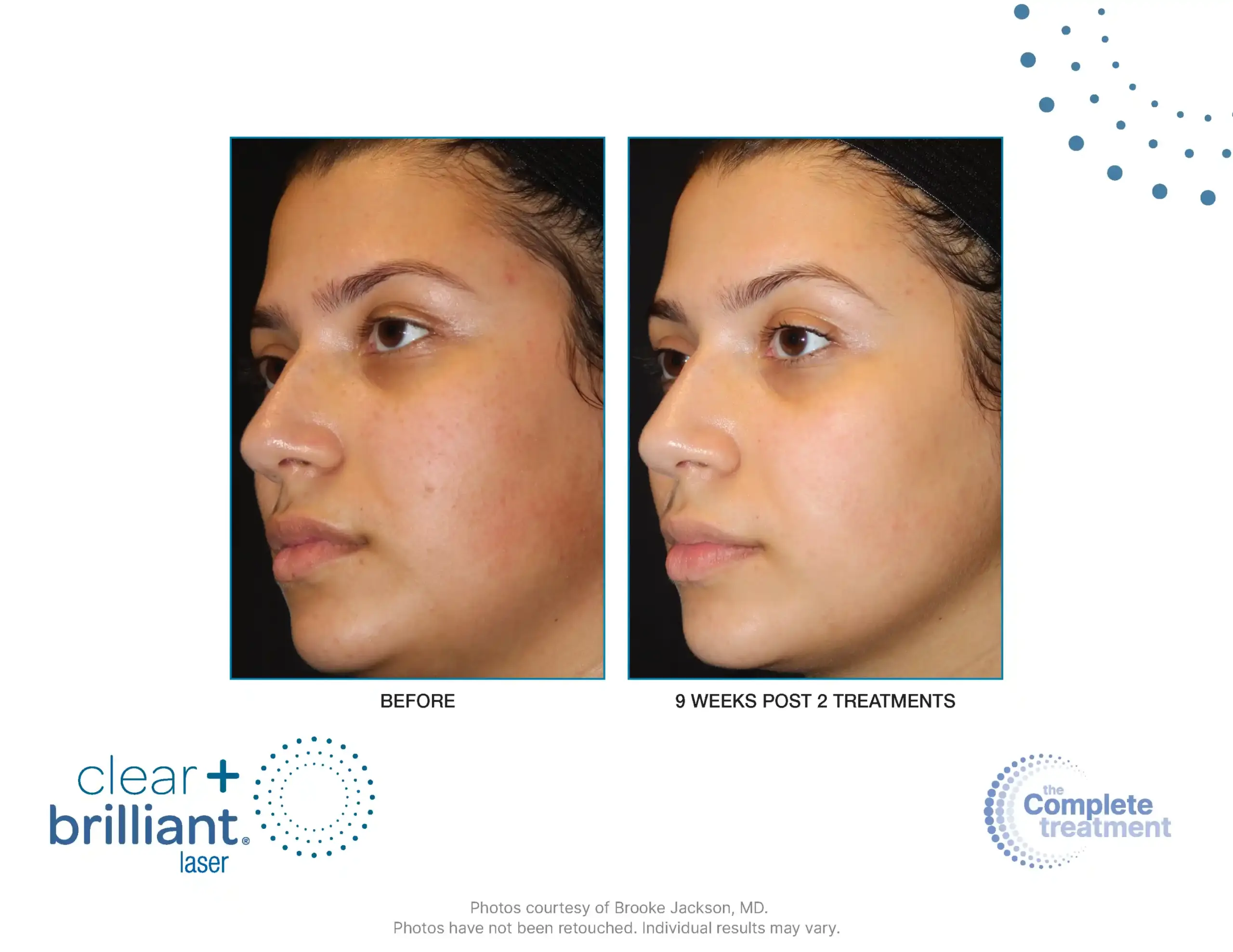 CB Touch B&A Master - 002-syracuse medical aesthetics in Syracuse, NY