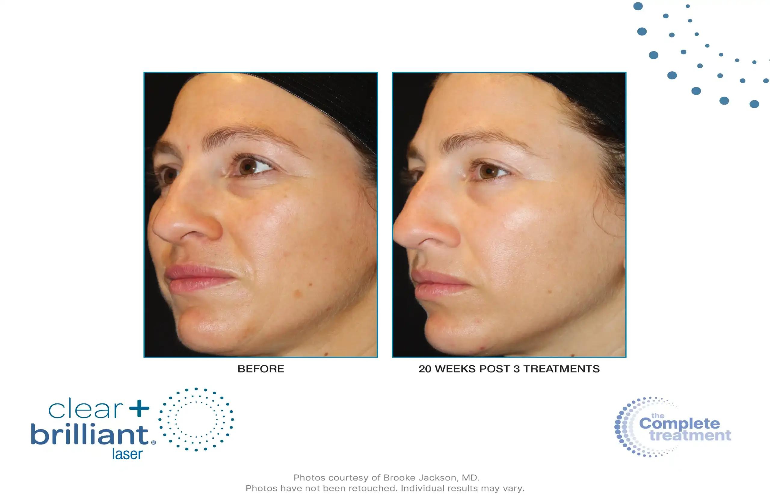 CB Touch B&A Master - 005-syracuse medical aesthetics in Syracuse, NY
