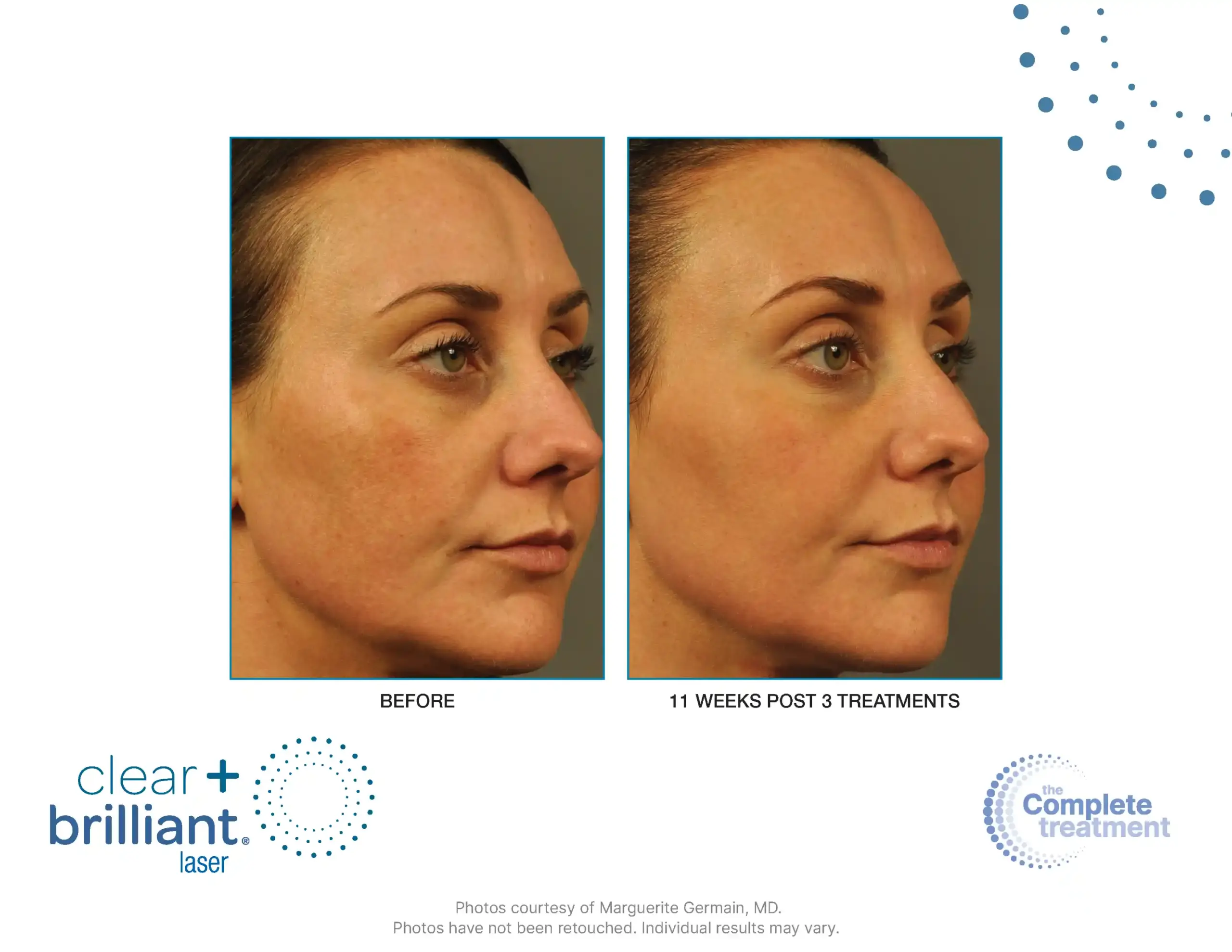 CB Touch B&A Master - 006-syracuse medical aesthetics in Syracuse, NY