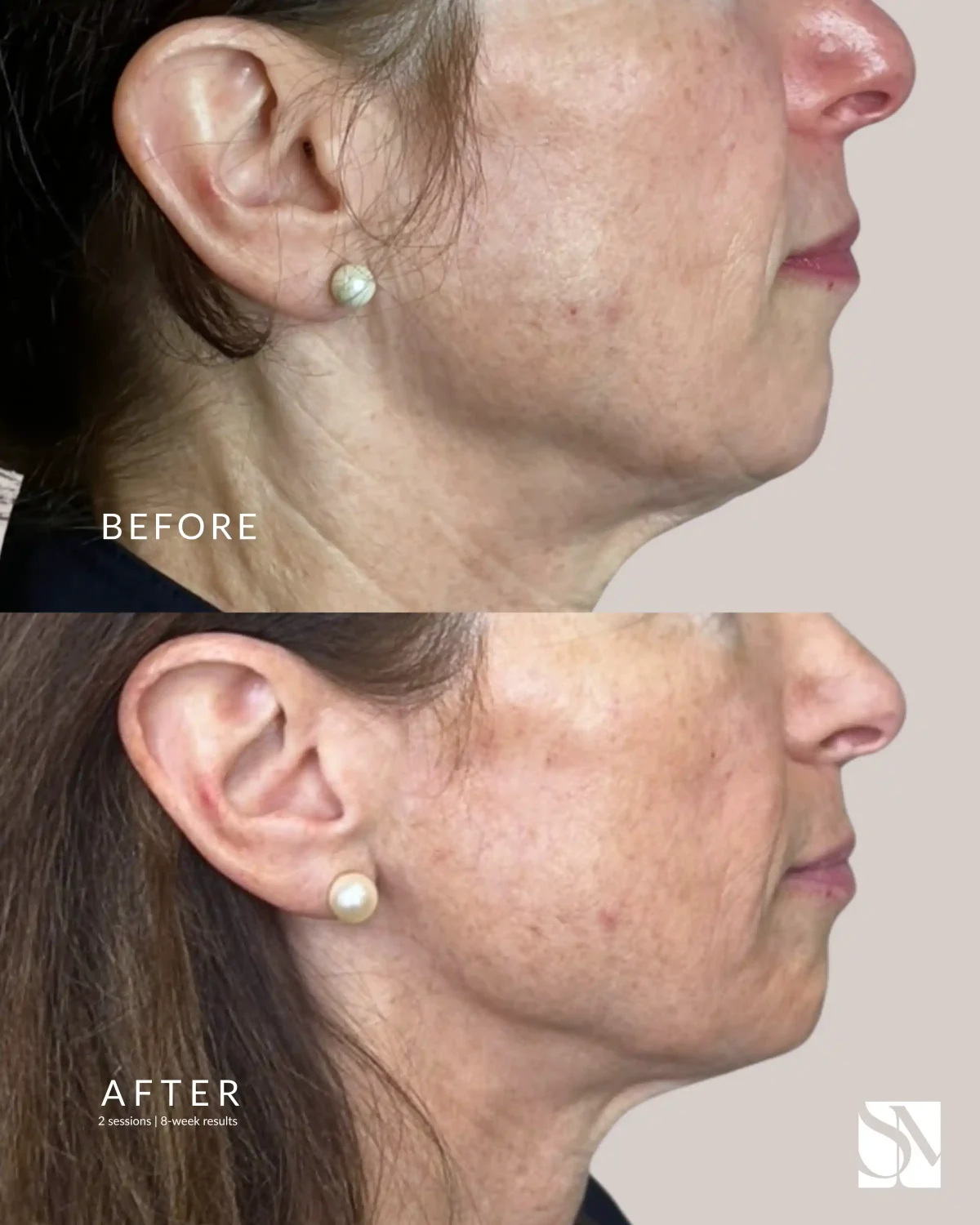 EVERESSE RF A-syracuse medical aesthetics in Syracuse, NY