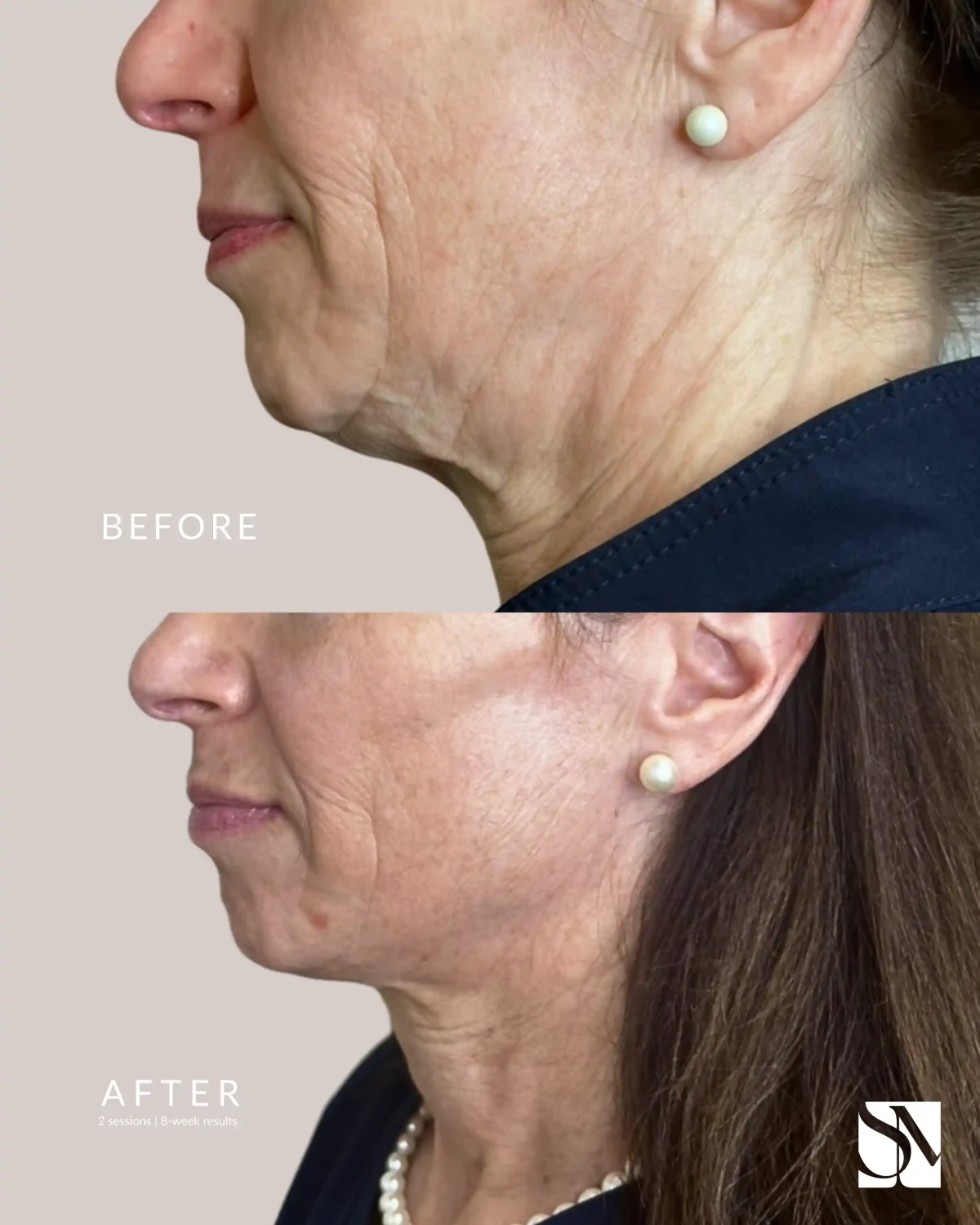 EVERESSE RF-syracuse medical aesthetics in Syracuse, NY