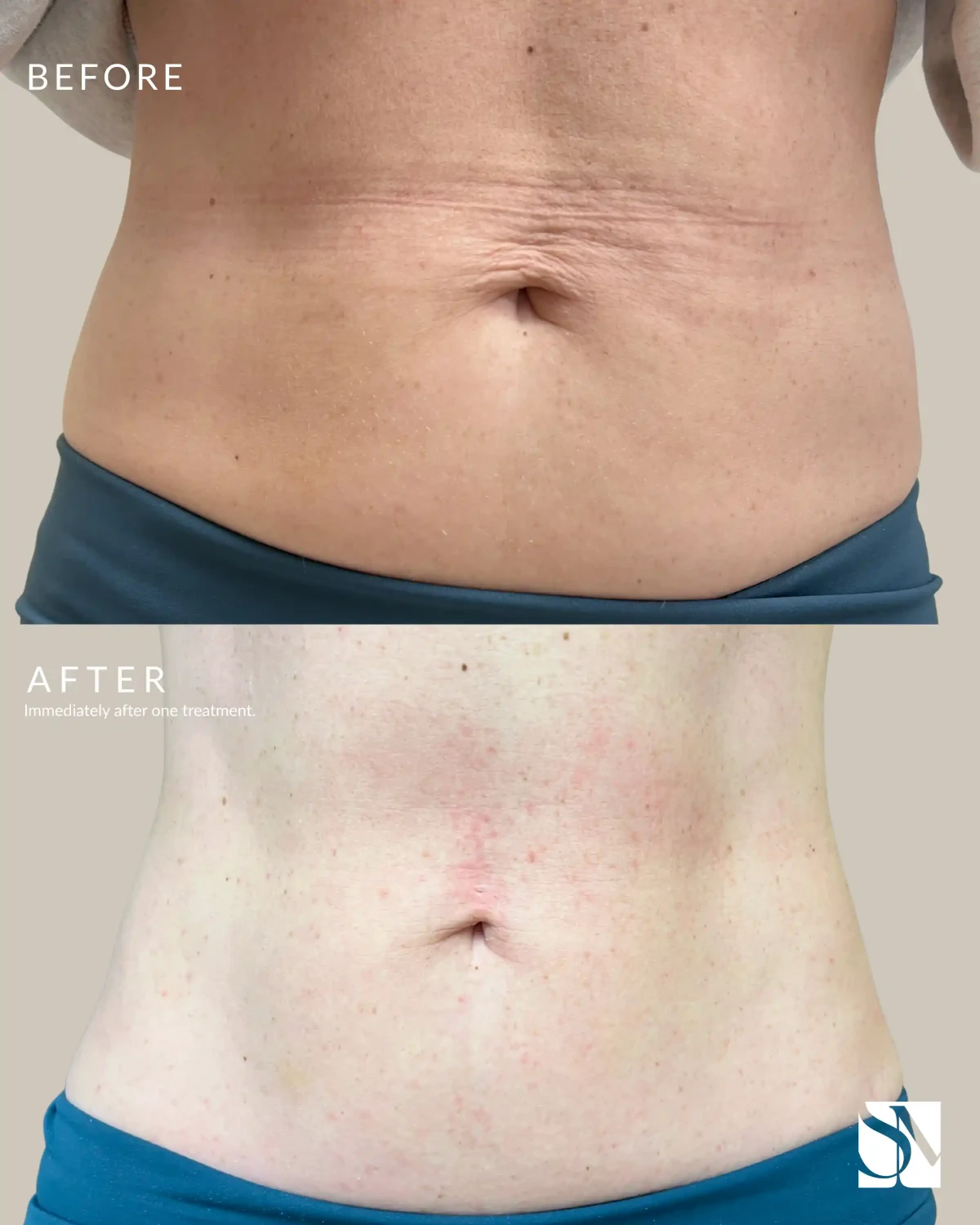 EVERESSE-syracuse medical aesthetics in Syracuse, NY