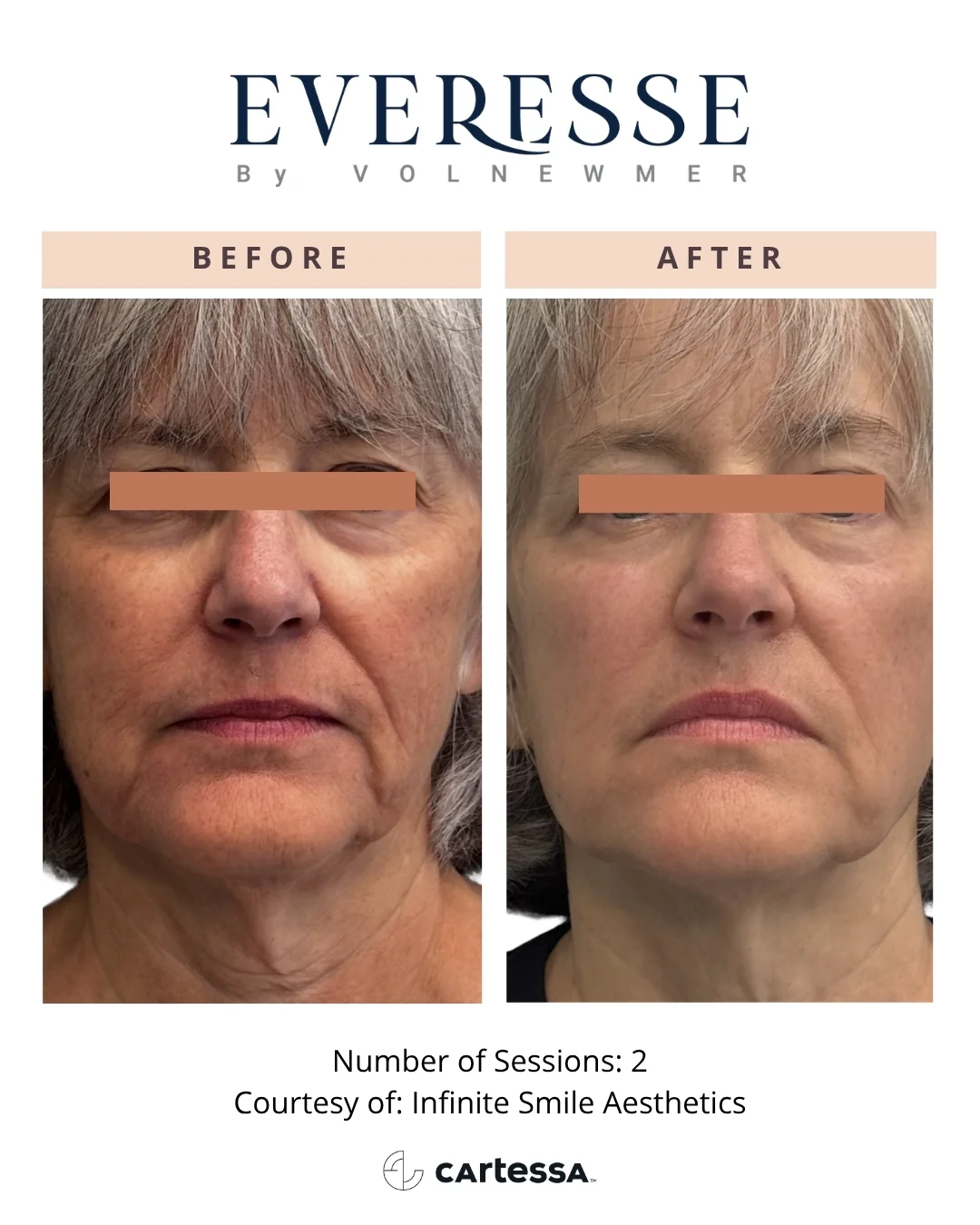 InfiniteSmileAesthetics-syracuse medical aesthetics in Syracuse, NY