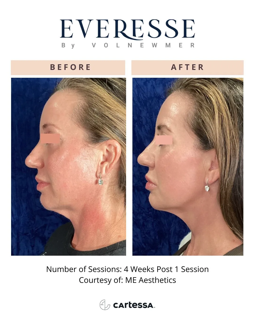 MEAesthetics-syracuse medical aesthetics in Syracuse, NY