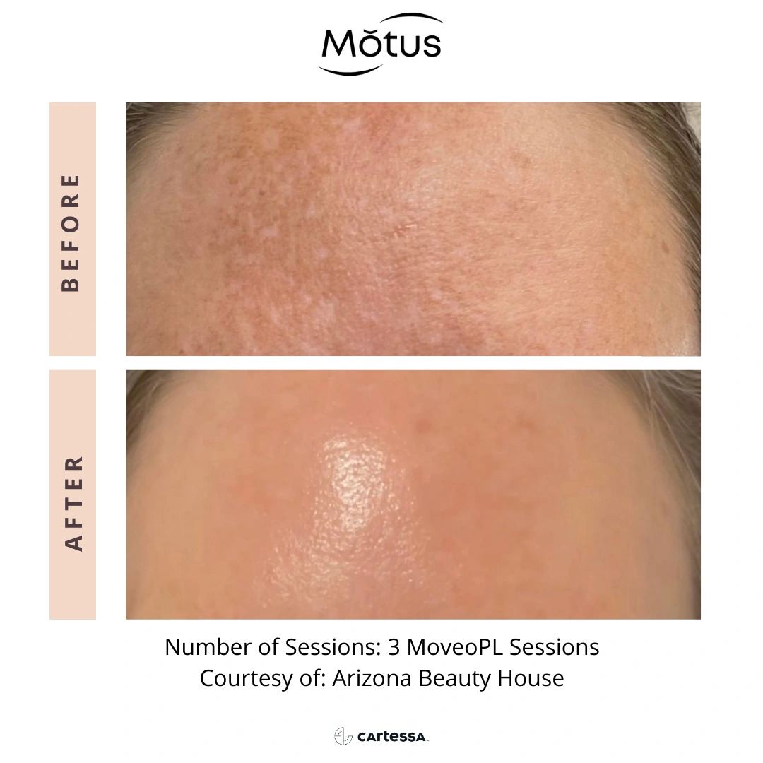 MotusAZ After-before-syracuse-medical-aesthetics-in-Syracuse-NY (1)