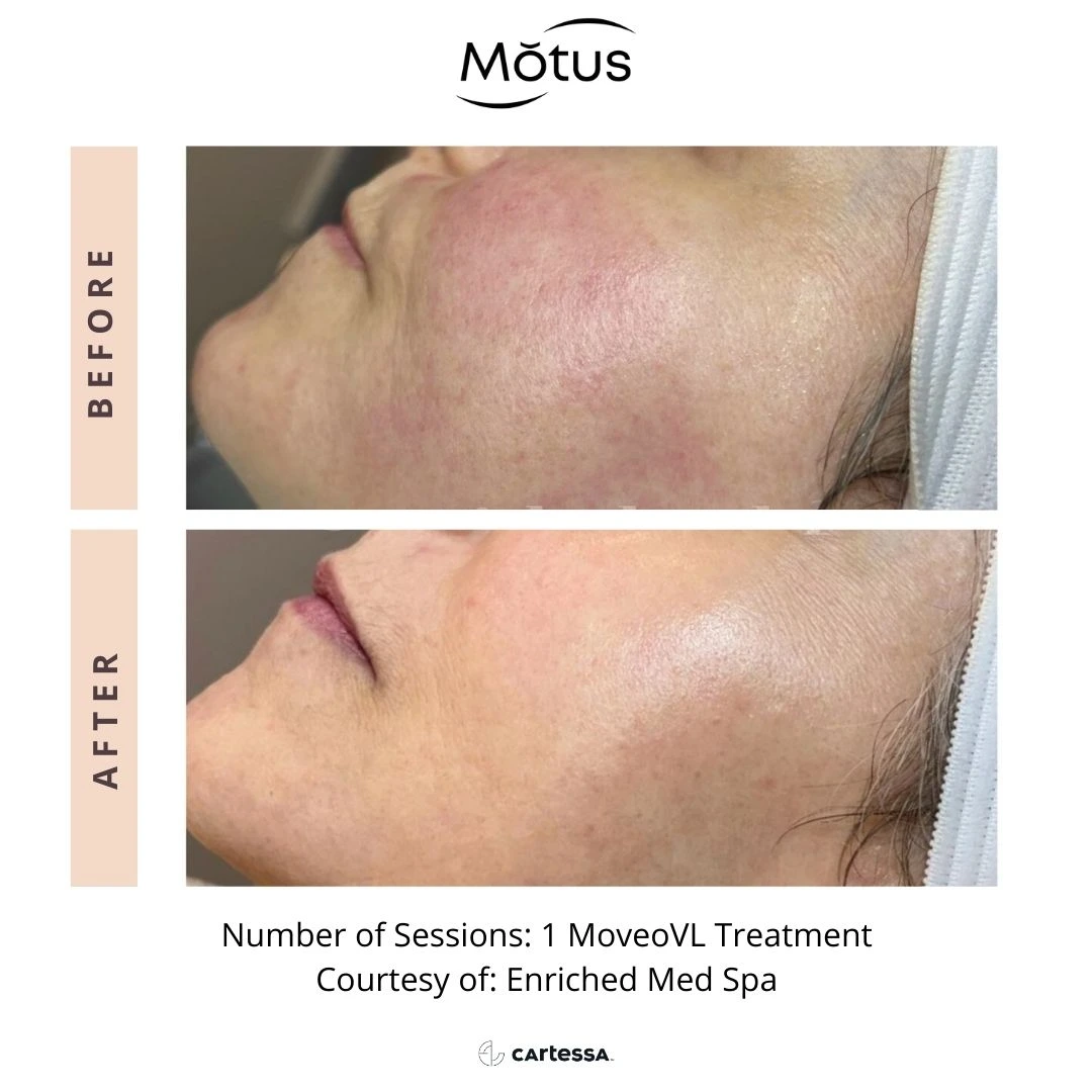 MotusAZ After-before-syracuse-medical-aesthetics-in-Syracuse-NY (2)