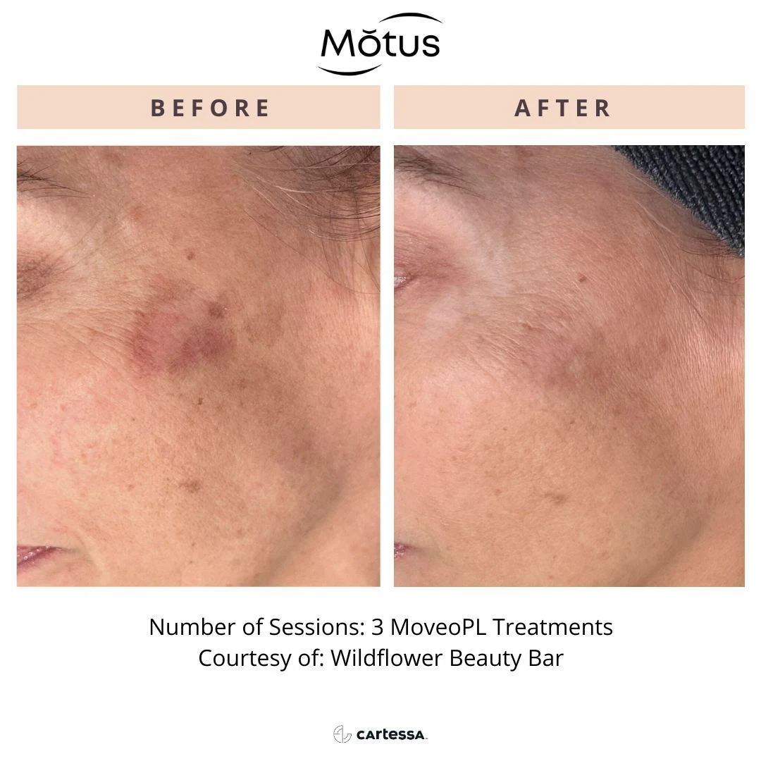 MotusAZ After-before-syracuse-medical-aesthetics-in-Syracuse-NY (3)