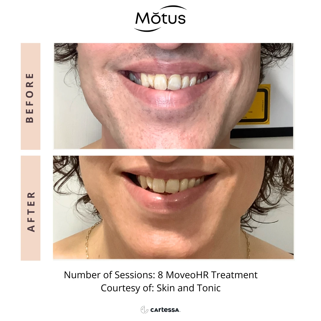 MotusAZ After-before-syracuse-medical-aesthetics-in-Syracuse-NY (4)