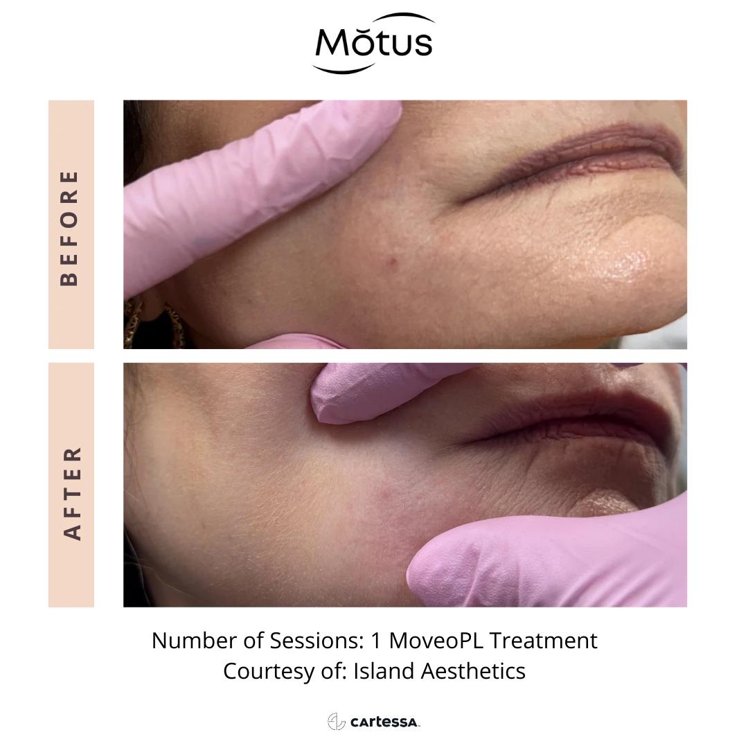 MotusAZ After-before-syracuse-medical-aesthetics-in-Syracuse-NY (5)