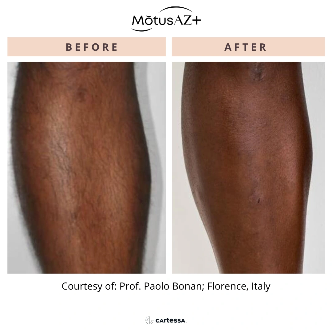 MotusAZ After-before-syracuse-medical-aesthetics-in-Syracuse-NY