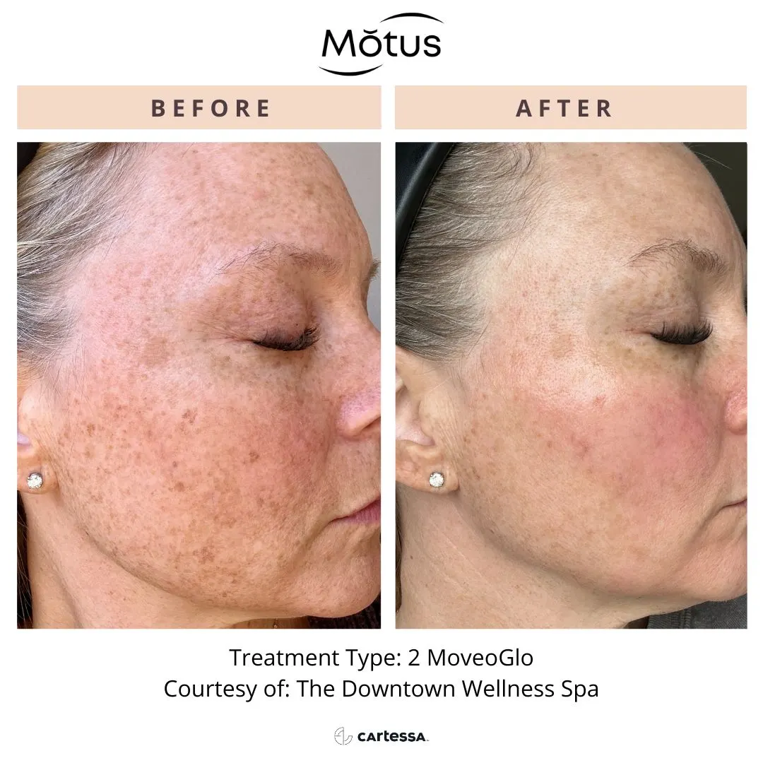 MotusAZ pro-syracuse-medical-aesthetics-in-Syracuse-NY