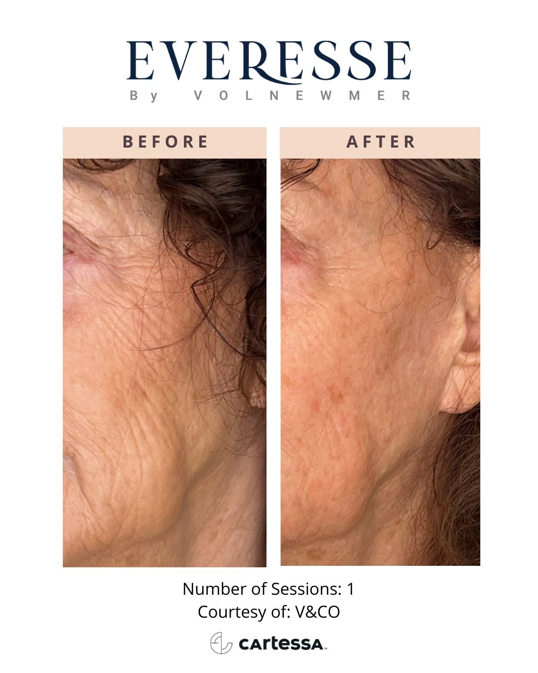 vnco-syracuse medical aesthetics in Syracuse, NY
